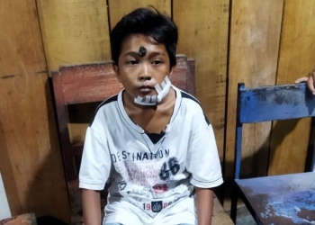 Salah seorang warga yang menjadi korban Gigitan aniing liar di Kelurahan Hunggaluwa Kecamatan Limboto. (Istimewa)