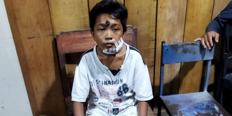 Salah seorang warga yang menjadi korban Gigitan aniing liar di Kelurahan Hunggaluwa Kecamatan Limboto. (Istimewa)