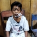 Salah seorang warga yang menjadi korban Gigitan aniing liar di Kelurahan Hunggaluwa Kecamatan Limboto. (Istimewa)