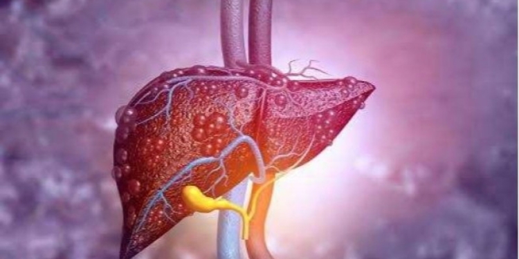 Hepatitis Akut atau Hepatitis Misterius. (Suara.com)