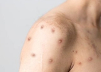 Ilustrasi penyakit cacar monyet atau monkeypox. (Pixabay/Suara.com)