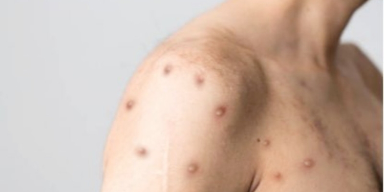 Ilustrasi penyakit cacar monyet atau monkeypox. (Pixabay/Suara.com)