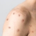 Ilustrasi penyakit cacar monyet atau monkeypox. (Pixabay/Suara.com)