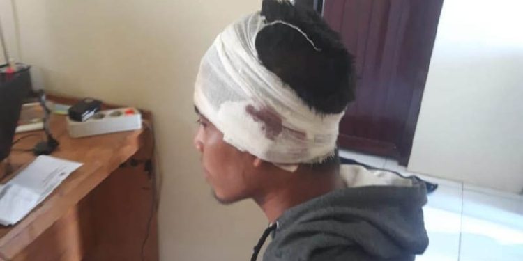 Suleman Adam alias Ucil kehilangan telinga kirinya setelah digigit temannya usai pesta miras bersama