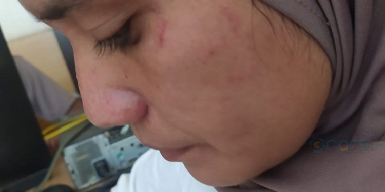 Vidya Mbuinga guru SDN 13 Paguat yang menjadi korban penyerangan oknum orang tua siswa berinisial SM (31).