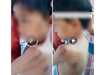Kondisi sang bocah yang mengalami luka lebam di beberapa bagian tubuh akibat diduga dianiaya ibu tirinya.